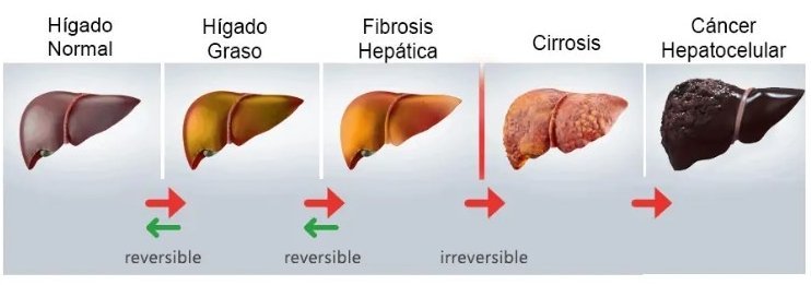 Hígado graso: causas y tratamiento nutricional